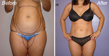 sculpsure-before-and-after