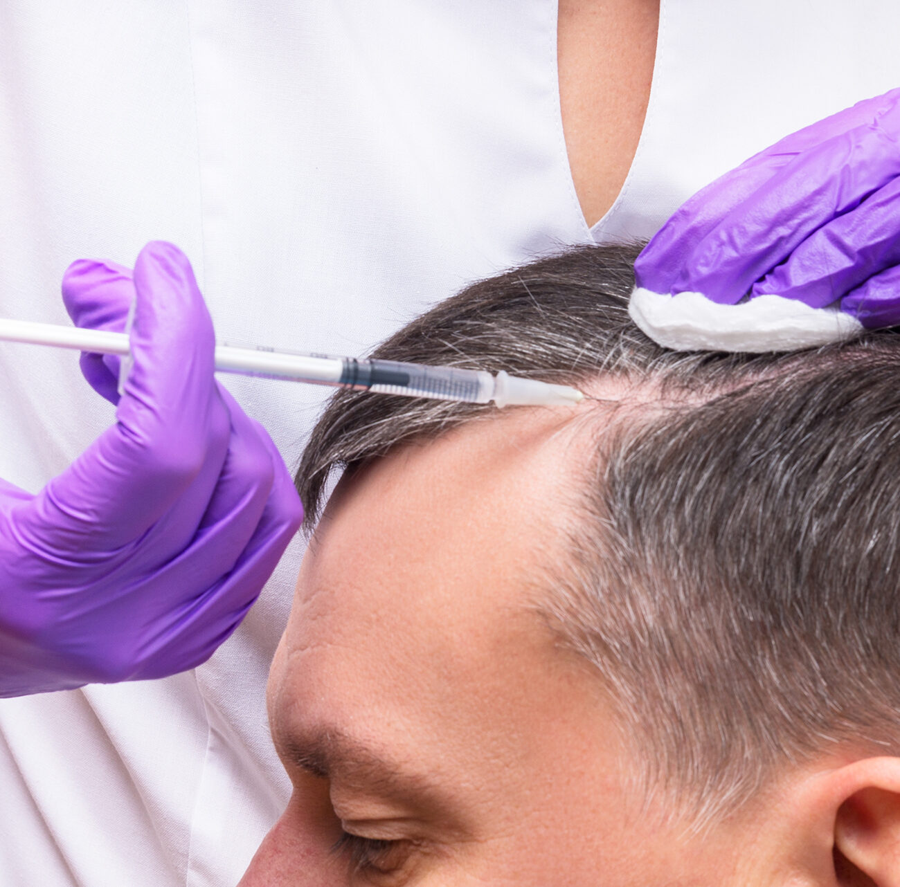 PRP for hair loss in miami