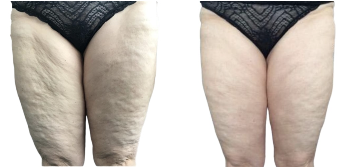 ONDA PRO jawline and skin tightening before and after at Dermacare MD Brickell Miami