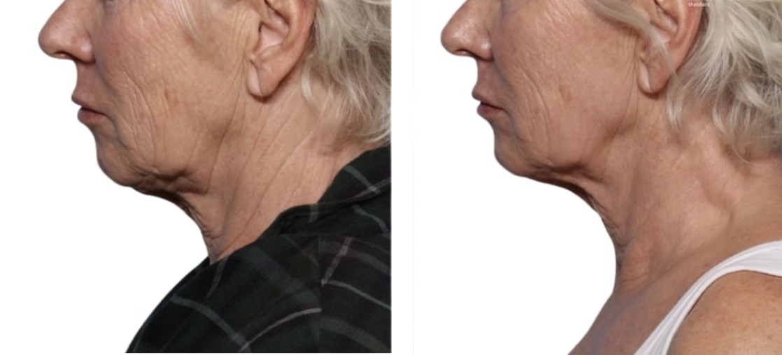 ONDA PRO cellulite before and after results at Dermacare MD Brickell Miami