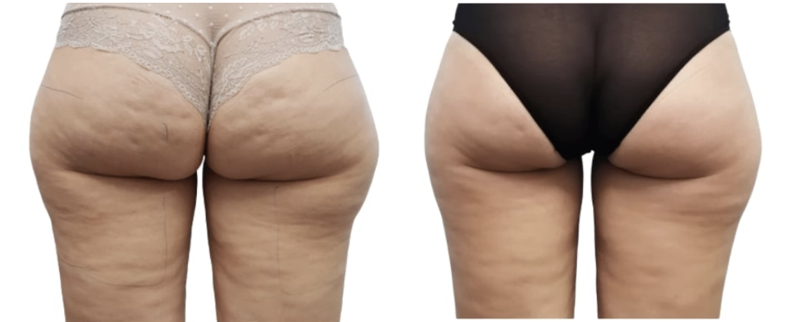 ONDA PRO jawline and skin tightening before and after at Dermacare MD Brickell Miami