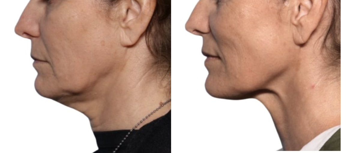 ONDA PRO cellulite before and after results at Dermacare MD Brickell Miami